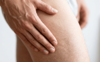 Männliche Hand streichelt nachdenklich über Oberschenkel mit Orangenhaut, symbolisiert Reflexion über Cellulite.